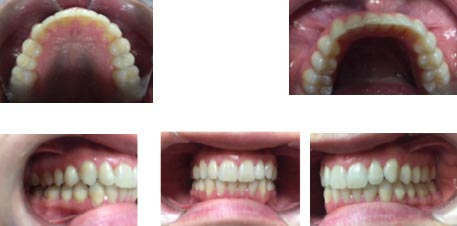 ortodoncia invisible para casos moderados y severos de dientes apiñados - Dra. Sara Gil - Ortodoncista