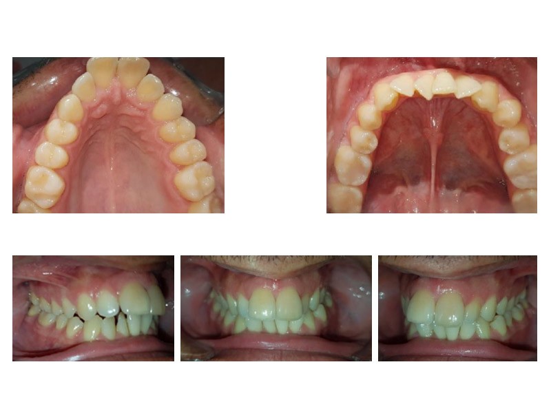 Maloclusión Clase II Bilateral corregida con Ortodoncia Invisible - Dra. Sara Gil - Ortodoncista