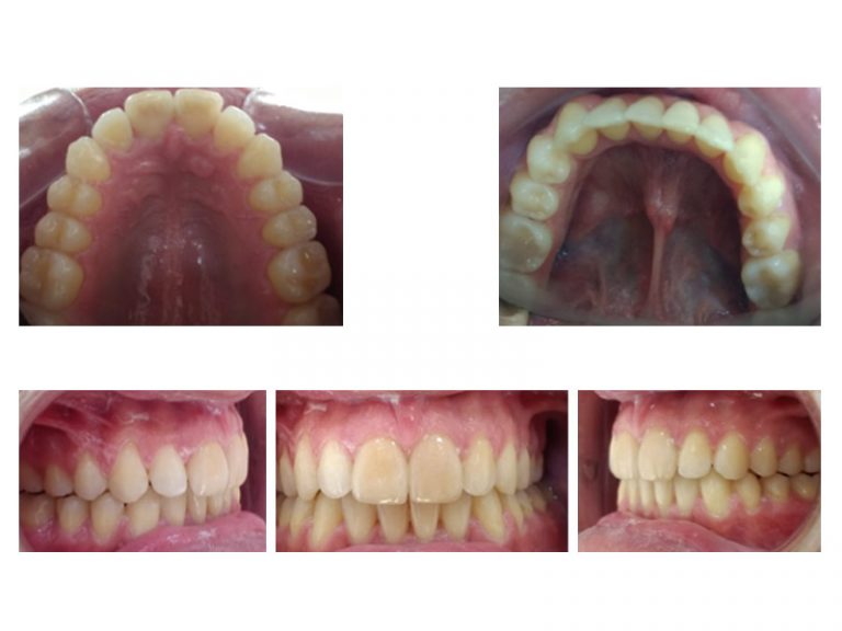 Maloclusión Clase II Bilateral corregida con Invisalign Dra. Sara Gil Maloclusión Clase II Bilateral corregida con Invisalign Dra. Sara Gil