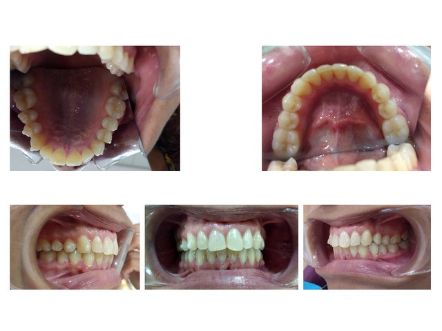 giroversión dental