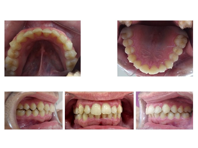 Caso real - apiñamiento dental severo corregido por Invisalign 