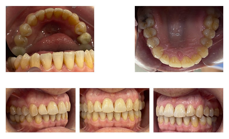 Caso de apiñamiento corregido con ortodoncia invisible - Dra. Sara Gil - Ortodoncista
