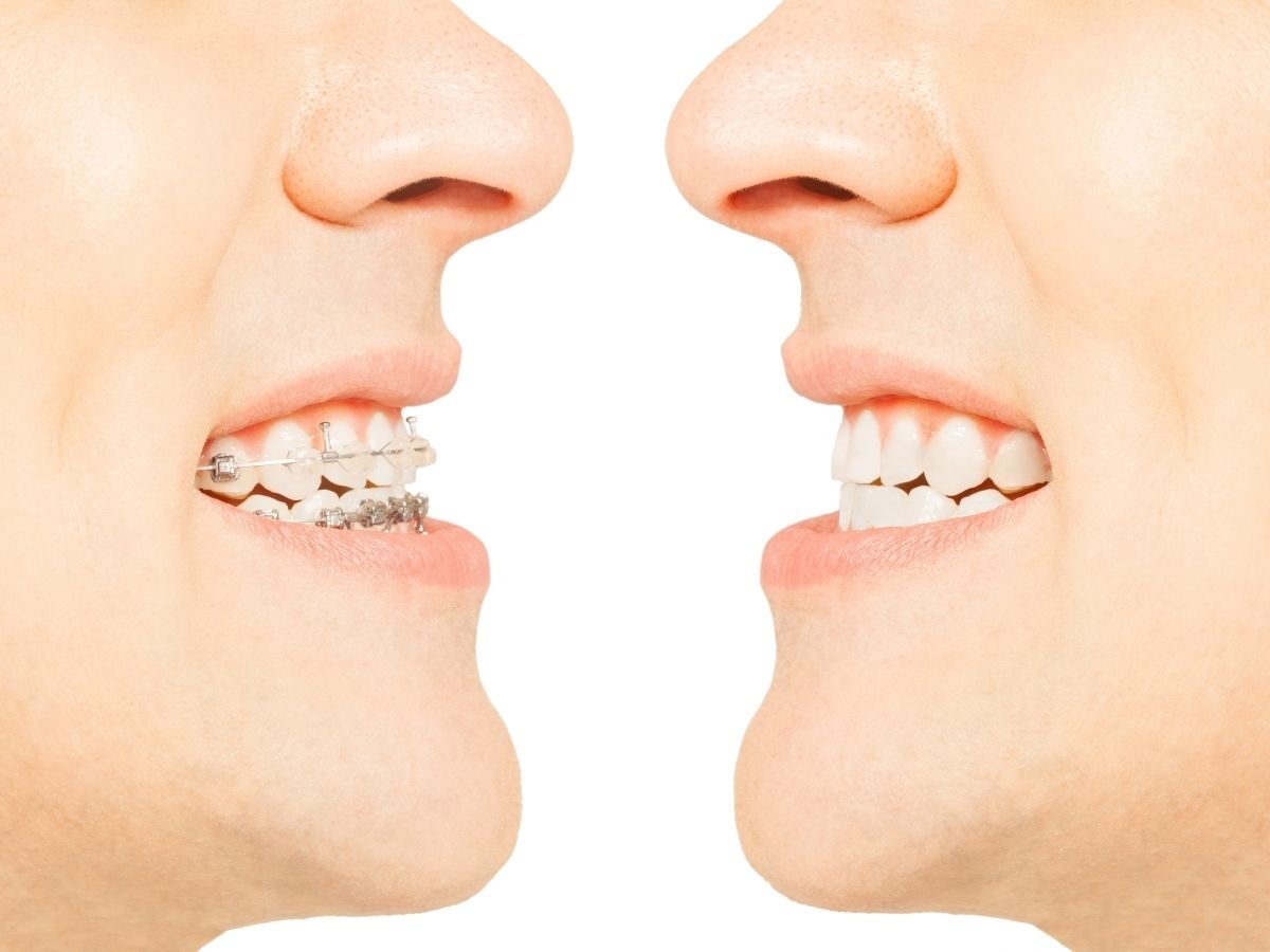 Asimetría facial con ortodoncia