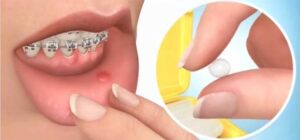 Cera dental para ortodoncia: cómo usarla