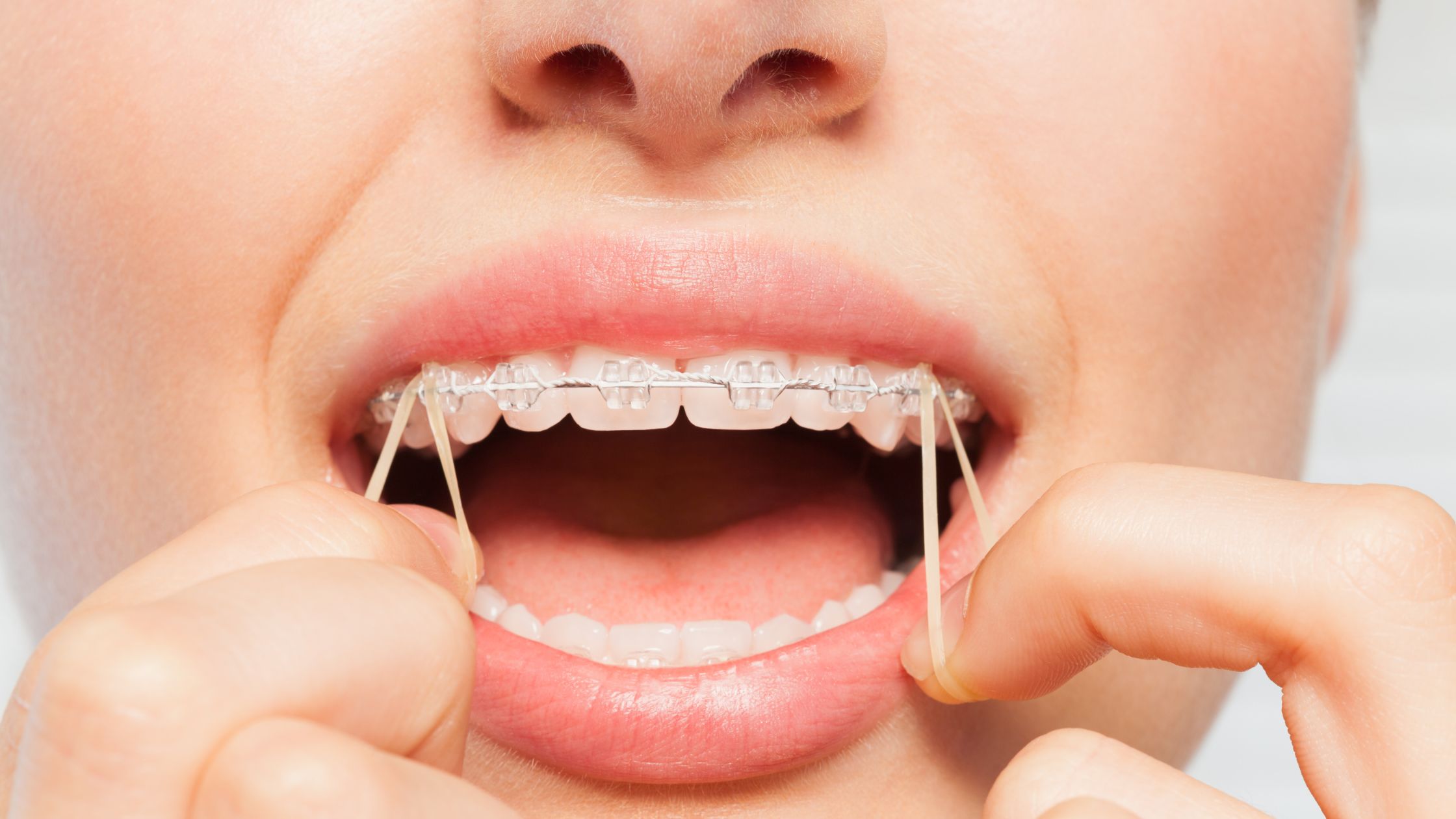 Elásticos intermaxilares en ortodoncia, ¿para qué sirven las gomas de los brackets?